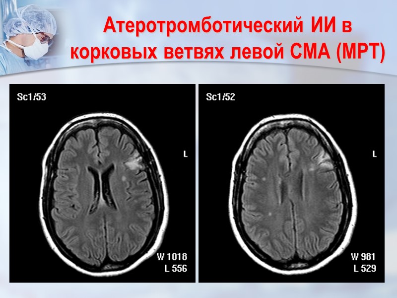 Атеротромботический ИИ в корковых ветвях левой СМА (МРТ)